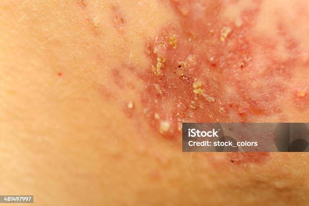 Acne On Her Face Stock Photo - Download Image Now - Acne, Extreme Close-Up, Macrophotography
