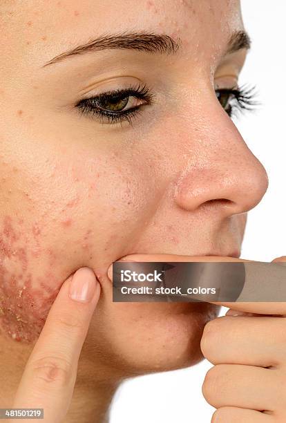 Remover Acne - Fotografias de stock e mais imagens de 16-17 Anos - 16-17 Anos, 18-19 Anos, Abcesso