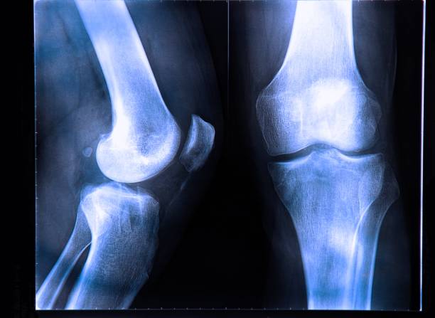 image au rayon x si le genou humain - x ray human knee orthopedic equipment human bone photos et images de collection