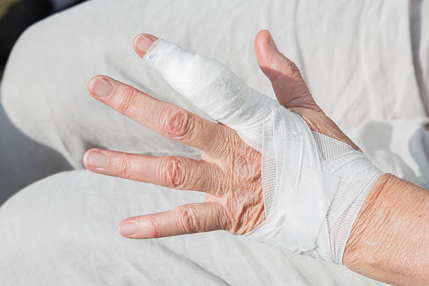 ganglion cysta tři dny po operaci - ganglion - stock snímky, obr