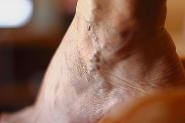 les varices - venous insufficiency photos et images de collection