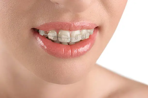 Photo of Teeth alignment. Braces. Beautiful woman smiling.