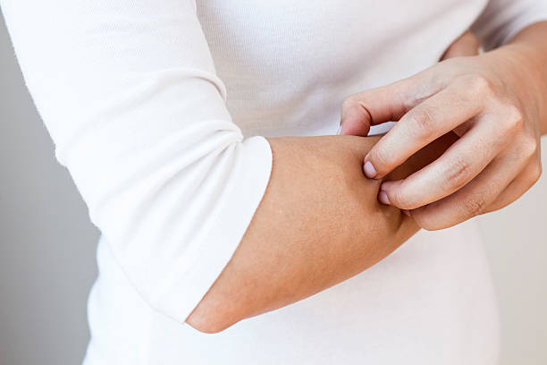 Scratching Caucasian woman is scratching her arm. Torso of woman with white shirt and jeans is shown under natural light, horizontal bloodsucking photos stock pictures, royalty-free photos & images