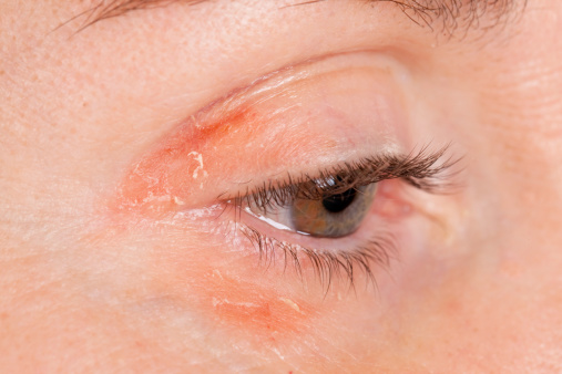 Close up of psoriasis on a female eye.  rr