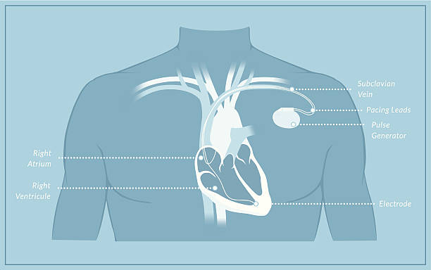 박동조율기 다이어그램 라벨 - pacemaker torso chest male stock illustrations