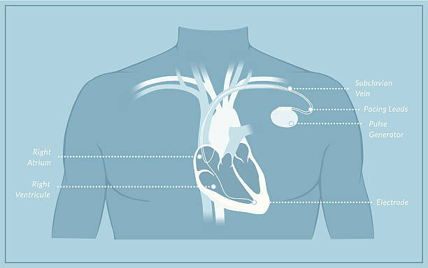 Generic Pacemaker Image 1.400+ Pacemaker Stockillustraties, royalty-free vector illustraties en ...