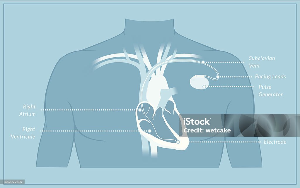 Pacemaker Diagram with Labels Cross section of human heart with a pacemaker fitting, showing the major arteries and veins. Pacemaker stock vector
