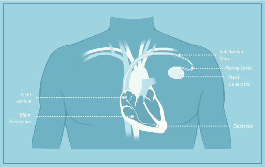 Pacemaker Sample Pacemaker Diagram With Labels Stock Illustration - Download Image Now ...