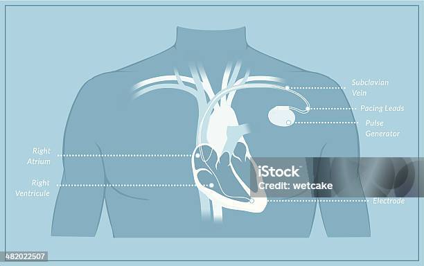 Pacemaker Diagram With Labels Stock Illustration - Download Image Now - Pacemaker, Diagram, Illustration