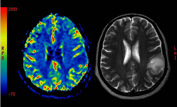 perfusion mri de imagens positivo de um tumor cerebral - mri scan human nervous system brain medical scan - fotografias e filmes do acervo