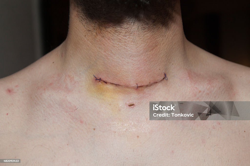 Glande thyroïde scar - Photo de Cicatrice libre de droits