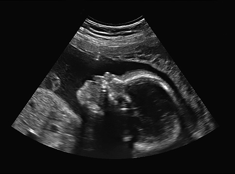 black and white ultrasound of baby in pregnant woman