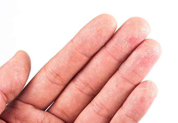 istock Closeup of Eczema Dermatitis 482245147