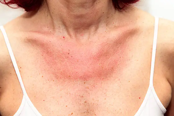 Woman with sunburns and Allergic reaction after unprotected sunbathing, acute state