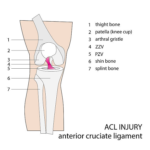 acl verletzungen - cruciate ligament stock-grafiken, -clipart, -cartoons und -symbole