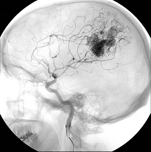 arteriovenous malformation (avm) in das gehirn - endhirn stock-fotos und bilder