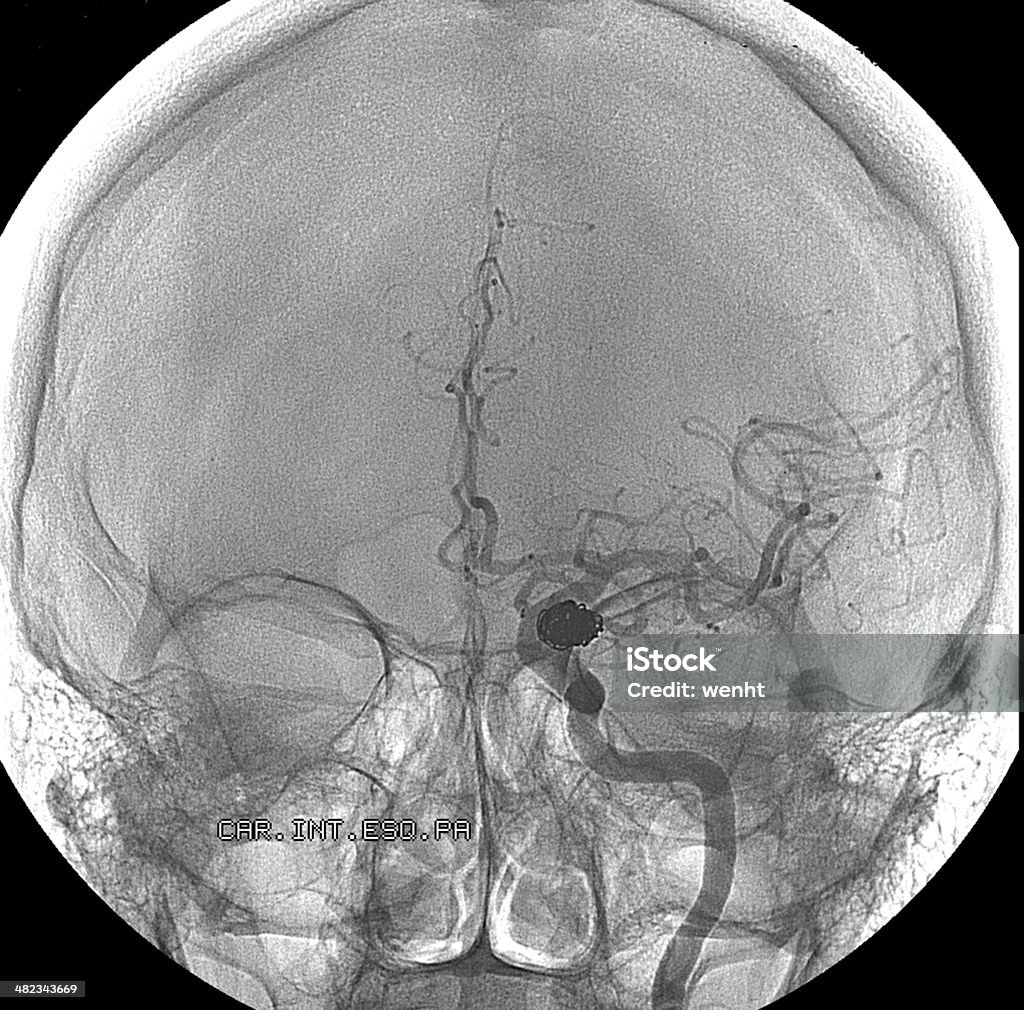 Embolization pour traiter Anévrysme dans le cerveau - Photo de Anévrysme libre de droits