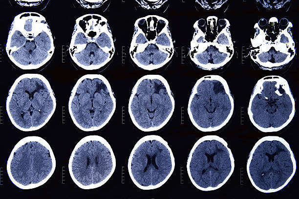 istock images from a computerized tomography of the brain 482371570