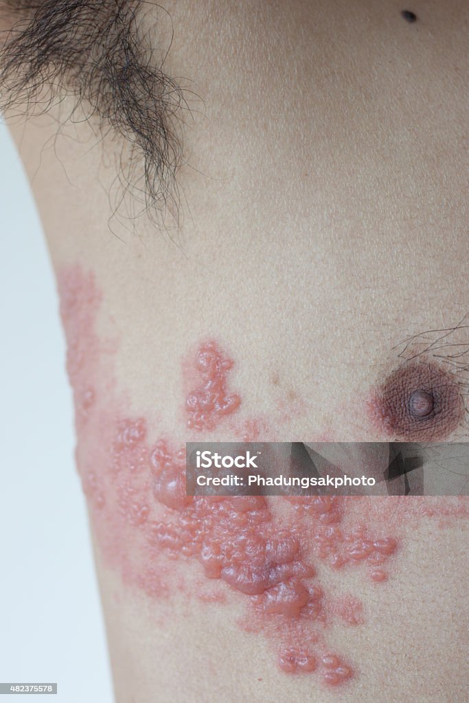 Shingles Patients Herpes zoster 2015 Stock Photo