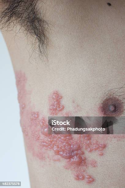 Shingles Patients Stock Photo - Download Image Now - 2015, Allergy, Blister