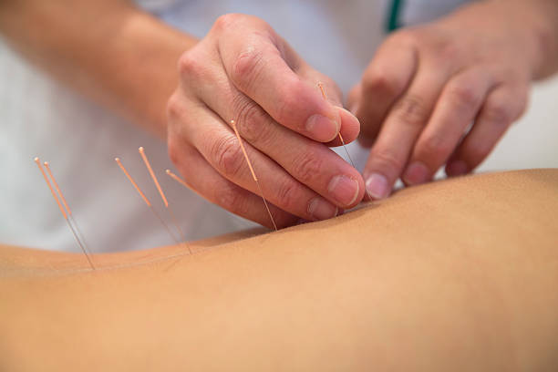 Treatment by acupuncture Acupuncture needles on back of a young woman acupuncture photos stock pictures, royalty-free photos & images