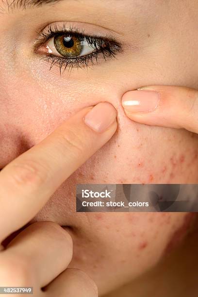 Problemi Di Acne - Fotografie stock e altre immagini di Acne - Acne, Ormone, Donne