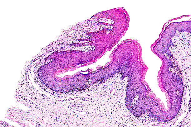 istock Skin papilloma of a human 482700602