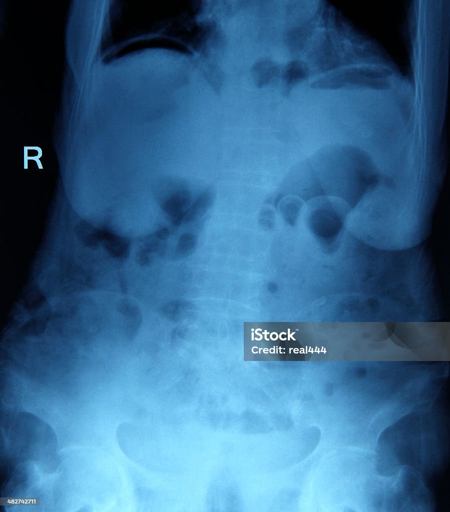 Vertebra radiografie - Foto stock royalty-free di Addome umano