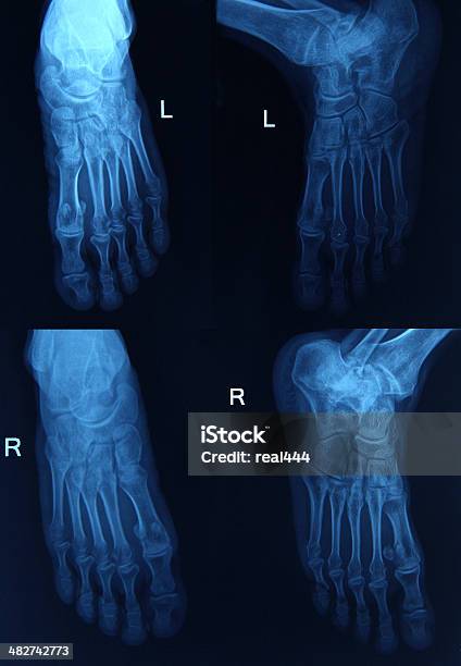 Imagen De Rayos X De La Pata Foto de stock y más banco de imágenes de Articulación - Articulación, Articulación humana, Dedo del pie humano