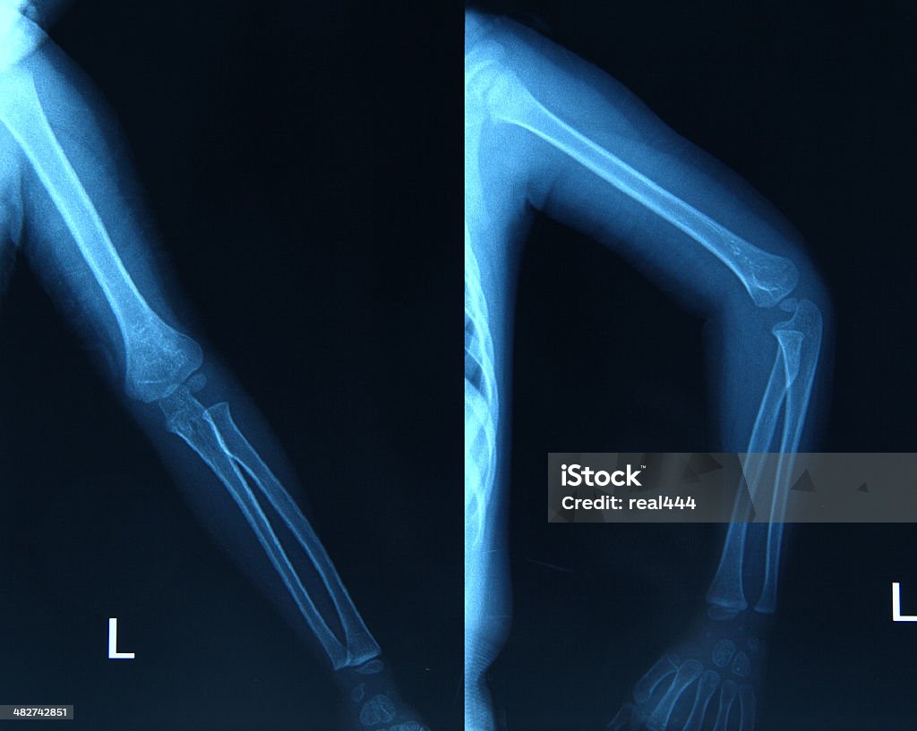 Imagem de raios X mãos - Foto de stock de Articulação Humana - Termo anatômico royalty-free