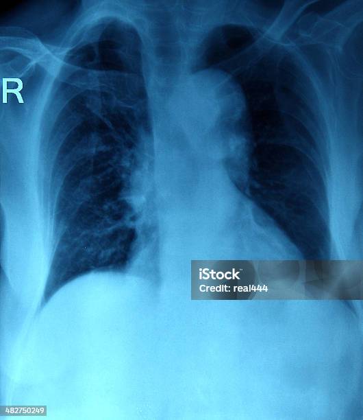 Radiografia Del Torace - Fotografie stock e altre immagini di Cavità toracica - Cavità toracica, Clavicola, Close-up