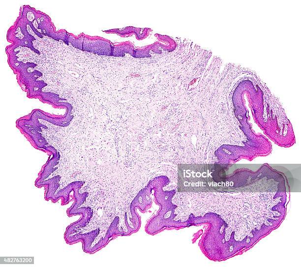 Papiloma De La Piel De Un Humanos Foto de stock y más banco de imágenes de 2015 - 2015, Asistencia sanitaria y medicina, Aumento a gran escala