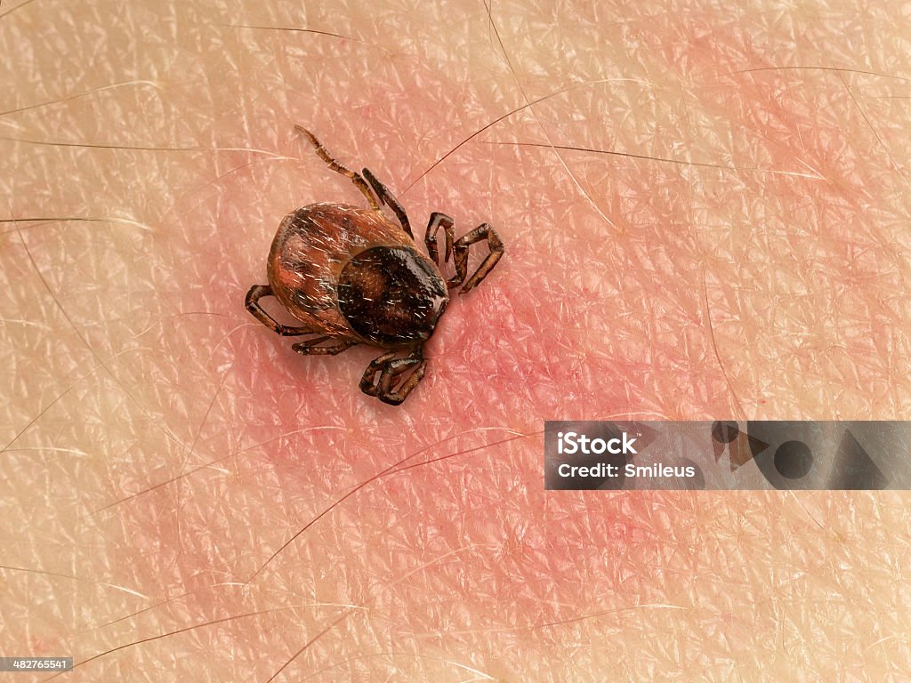 Tick bite Tick with its head sticking in human skin, red blotches indicate an infection Tick - Animal Stock Photo