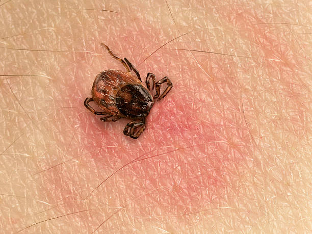 Tick bite Tick with its head sticking in human skin, red blotches indicate an infection bloodsucking photos stock pictures, royalty-free photos & images