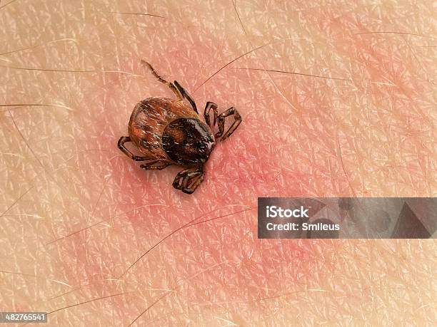 Tick Bite Stock Photo - Download Image Now - Tick - Animal, Lyme Disease, Biting