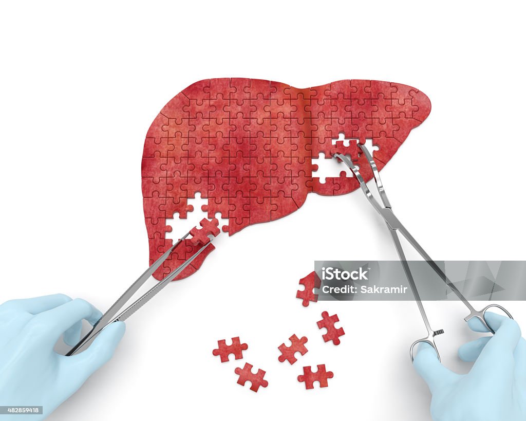 Liver operation Liver operation puzzle concept: hands of surgeon with surgical instruments (tools) performs liver surgery as a result of hepatic disorder (cirrhosis, hepatic cancer, hepatitis, hepatectomy) Liver - Organ Stock Photo