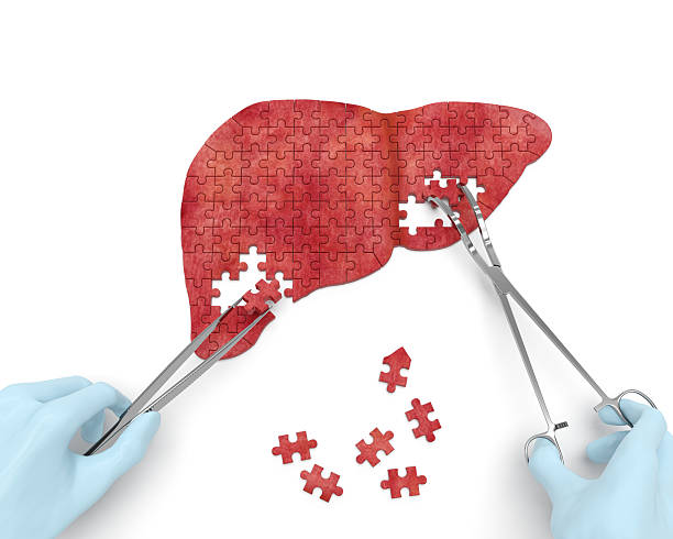 Liver operation Liver operation puzzle concept: hands of surgeon with surgical instruments (tools) performs liver surgery as a result of hepatic disorder (cirrhosis, hepatic cancer, hepatitis, hepatectomy) hepatitis photos stock pictures, royalty-free photos & images