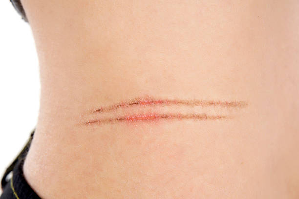 scar on female skin stock photo