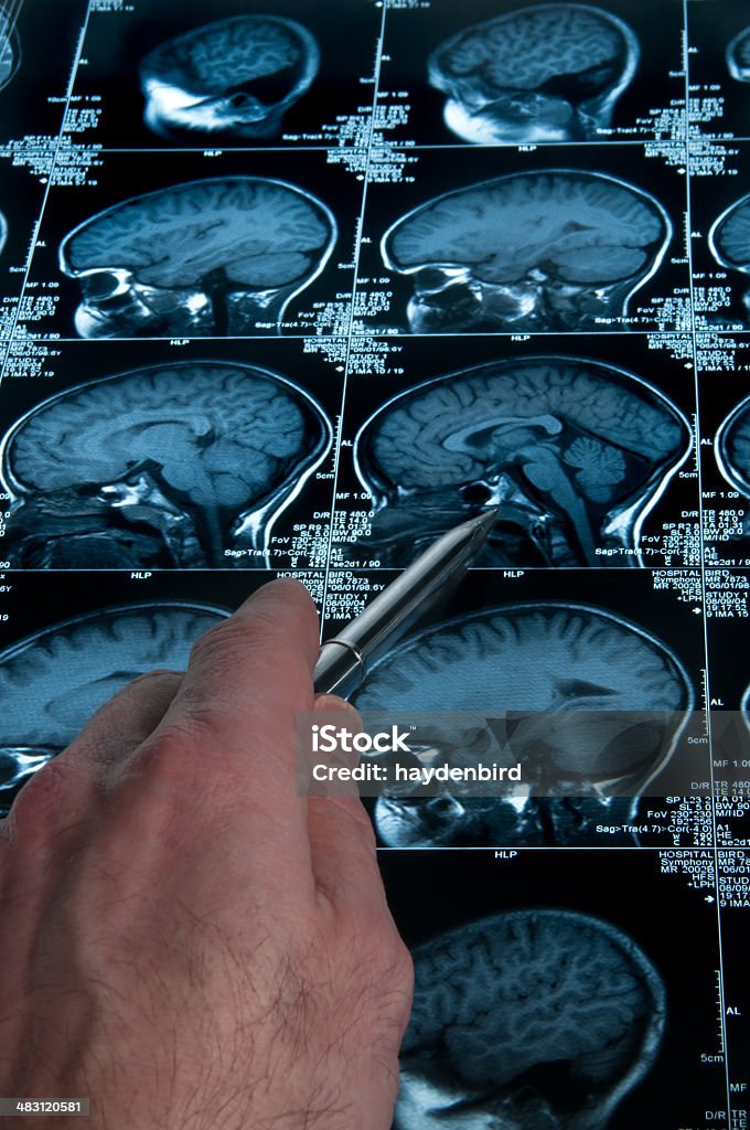 Scanner à résonance magnétique de cerveau tête crâne et os avec Main pointant du doigt - Photo de Épilepsie libre de droits