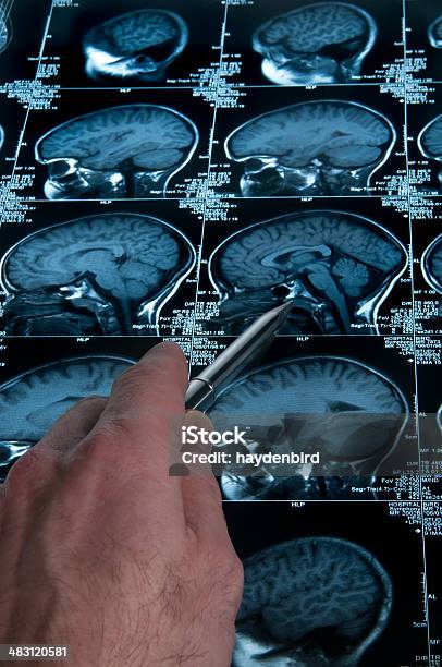 Mri 脳スキャンの頭とスカル指を指す手 - てんかんのストックフォトや画像を多数ご用意 - てんかん, X線撮影, アルツハイマー病