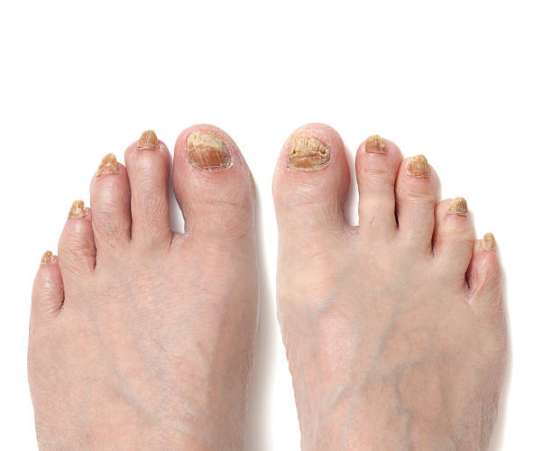 todos os dedos dos pés, doença de fungo a par dos pés - fungus toenail human foot onychomycosis - fotografias e filmes do acervo