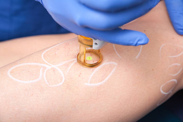 Medical laser, spider veins Removal of spider veins by laser treatment spider veins stock pictures, royalty-free photos & images