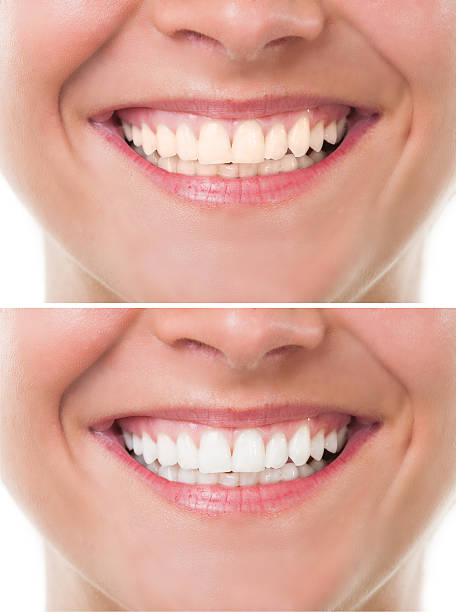 Before and after bleaching or whitening stock photo