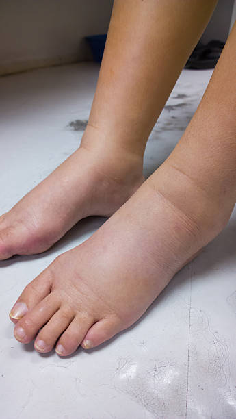 Gross edema of leg and foot stock photo