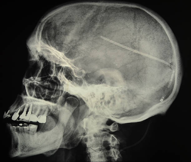 Skull radiography This side view of a skull radiography shows a catheter located in the brain. This catheter is part of a device called ventriculo-peritoneal shunt. cerebrospinal fluid photos stock pictures, royalty-free photos & images