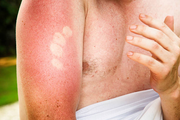 istock Painful sunburn marks on upper male arm 483421278