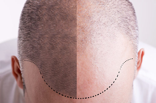 Caída del cabello, antes y el después photo