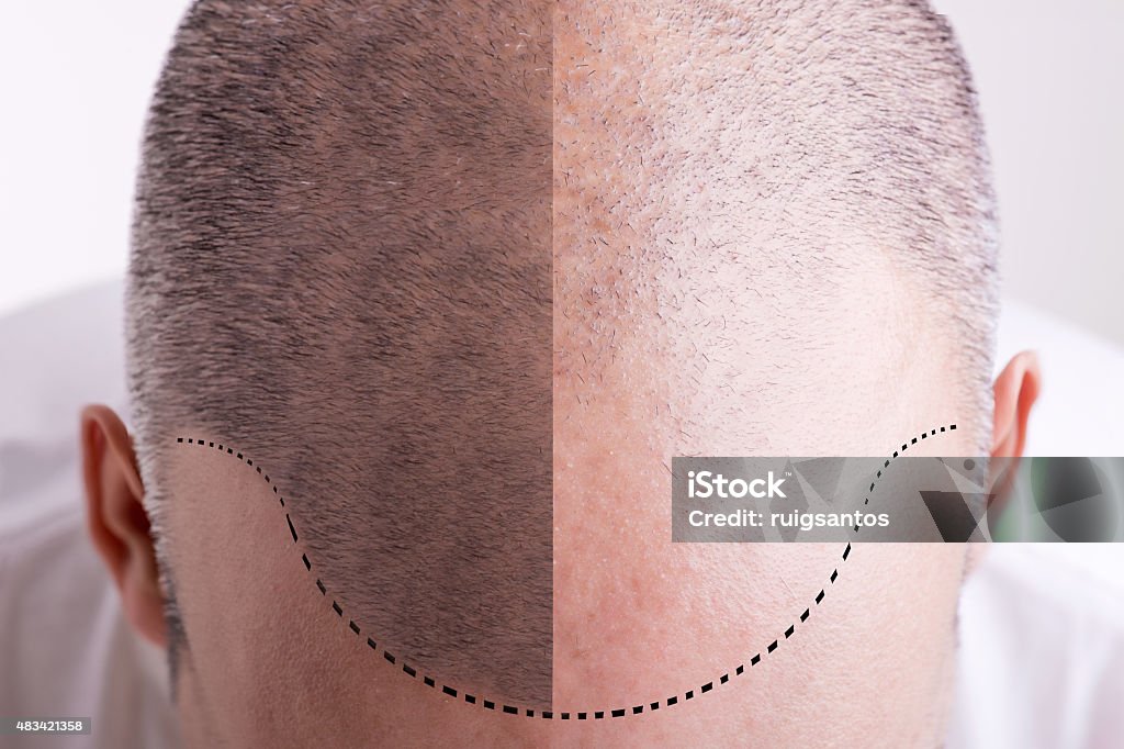 Hair Loss - Before and After Top view of a men's head with a receding hair line - Before and After Men Stock Photo