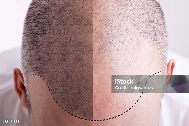 Hair Loss Before And After Stock Photo - Download Image Now - Men, Hair Loss, Before and After