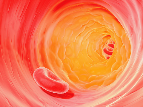 Atherosclerosis plaque prevents normal blood flow in affected artery. Medical background.